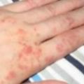 3年的慢性濕疹，老中醫一個簡單方子，可斷根還養顏嫩膚