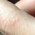 很多人都沒發現！「手指」突然出現這種小水泡…竟是大病前兆！！千萬要小心了…