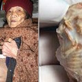 90歲老婆婆一直以為的「腫瘤」，直到看病才發現是子宮裡藏了驚人生物！沒想到醫生竟然因為這樣不願替他切除...