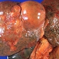 為何“肝癌”一發現就是晚期？你的肝若出現這三種症狀，就恐怖了...絕對要注意！！