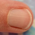 你的指甲上有一道道直線嗎？那你就要特別小心了！！可能是這種重大疾病的微兆…
