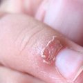 你的手指常常脫皮“倒刺指”嗎？千萬不要直接把皮撕下來，你應該要這樣做才對！