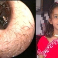 這個12歲的少女每天都會從耳朵冒出十隻「活螞蟻」！醫生掏出了1000多隻後，驚訝地發現她體內竟然是…看得我全身發癢難耐啊！!