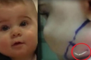 媽媽發現7個月大的寶寶臉上長出白色尖角，送醫才發現是...