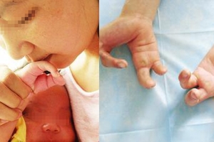 寶寶出生時手掌是“螃蟹手”！原因居然是媽媽做了“這種事”...讓醫生徹底憤怒了！