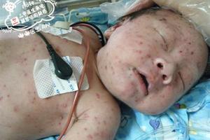 出生16天寶寶出水痘，媽媽竟然是「元兇」