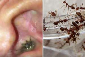 居然有螞蟻在印度女孩的耳朵裡築巢，醫生夾出上千隻螞蟻後，發現到一件更可怕的事實…