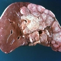 太可怕了！為何「肝癌」一發現就是晚期？你的肝若出現這些狀況，就出事了...絕對要注意！！