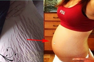 太神奇！！懷孕時塗這樣純天然的「東西」，就能有效預防「妊娠紋」！！