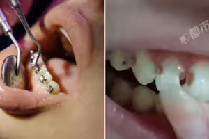牙齒蛀成大洞!妹子牙套戴5年「8顆牙爛掉」 醫聽潔牙習慣傻眼 牙齒蛀成大洞!妹子牙套戴5年「8顆牙爛掉」 醫聽潔牙習慣傻眼