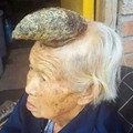 87歲阿嬤「頭長出角」被稱為「獨角獸女人」！找醫生把它切掉卻發生「驚人一幕」！原來這個角是… 