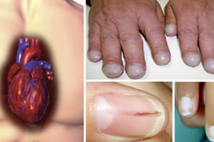  心臟病、肝硬化、肺腺癌「指甲」透端倪：趕緊自我檢測，「7種異常外觀」須警覺！