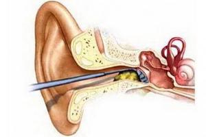 教你如何正確輕鬆清除堵塞耳朵裡的耳垢！必收藏！ 