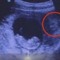 诡异！这张胎儿B超显示子宫外惊现〝恶魔〞！