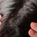 頭皮屑老是困擾你嗎？這3種方法比去屑洗髮精更有用！學起來，就不怕雪花老是飄在頭毛上了！