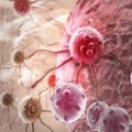 原來癌細胞是靠「它」才能長大變強，罹癌者只要沒有「它」癌細胞就會死光光！腫瘤縮小3分之1，連身體也健康了！