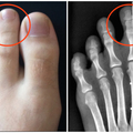原來擁有「希臘腳」不是好事！醫生說「第二隻腳趾比較長」的人一定要小心，因為一不小心就會．．．