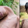 頭部只能掛胸前的印度男孩8個月前才手術成功正著看世界，現在他去世了...