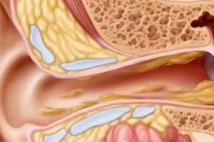 喜歡經常掏耳屎？多少人因此而變聾！耳科醫生建議這樣清理