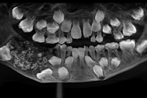 7歲男孩下顎長出「詭異肉包」　醫生一劃…驚見「526顆密集牙齒」