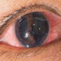 眼睛有紅血絲要警惕這幾種疾病
