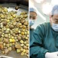 太愛吃豆腐　55歲男子身體裡有420顆結石　醫生取到手都麻了