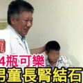 1天喝4瓶可樂　7歲男童長腎結石