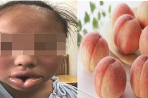 10歲女童咬了一口桃子嘴唇腫得像香腸(圖)