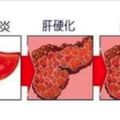 台灣曾被國際稱作是「肝病之國」，醫生警告：「這3種食物再碰，肝癌很快就會來！」&驚！血管堵塞時你不會有感覺，沒救時你才會知道！