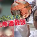 酒店實習燙壞手指22歲女大生被逼截斷4根手指!