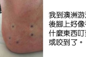 游泳上岸後發現「腳上有6個洞」　男子急PO網詢問　網友回：趕快砍掉它