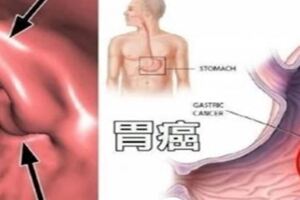 醫生勸告：早晨空腹時，千萬別碰這5種食物，會損傷胃粘膜，引發胃病