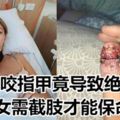 愛咬指甲竟導致絕症女需截肢才能保命