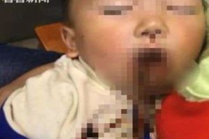 筷子插進嘴巴眼眶1歲半童滿臉鮮血