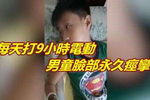 每天打9小時電動男童臉部永久痙攣