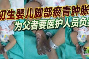 初生嬰兒腳部瘀青腫脹為父者要醫護人員負責