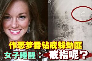 女子作惡夢吞戒指　手術被告知有死亡風險