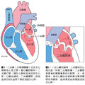 什麼是二尖瓣脫垂? 請仔細下列幾點