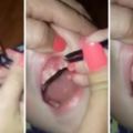 這個媽媽在「愛咬指甲」的兒子牙齦上夾出深嵌指甲，數量多到差點以為兒子是否變成了怪物！