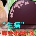 肝臟一旦「生病」了，手腳會出現4個變化，你若一個也沒有，肝臟還很健康