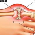 高尿酸、痛風的人註定與吃魚無緣？錯！這3種食物才真不該吃