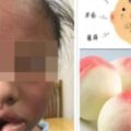 10歲女童咬了一口水蜜桃，嘴唇腫得像香腸，差點窒息