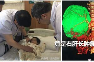 2歲女孩肚子像吹氣一樣越來越大，人卻越來越瘦！竟是右肝長腫瘤