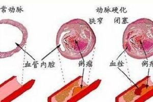 喝醋真的能軟化血管嗎？