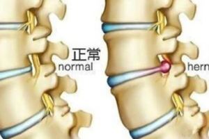 大棗加大蔥竟是腰椎間盤突出的終結者，治一好一，腰不好不要錯過