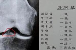 【骨刺的藥方】大公開！只喝了4天，就沒有痛了！沒找醫生開刀！