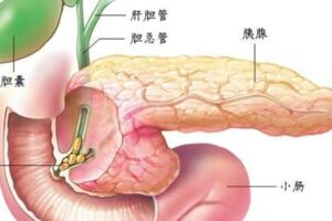 哪些食物吃多了會導致胰腺炎？該怎麼飲食預防？消化科醫師告訴你