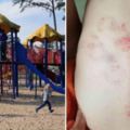 媽媽給上幼稚園的兒子洗澡，脫下上衣後竟然在他的背上發現了15個恐怖咬痕！