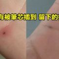 網友在網上求助「筆芯插到手裡該怎麼辦」，結果網民們都紛紛「曬出手上小黑點」！