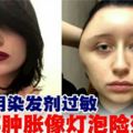 染發劑過敏少女頭部腫脹像燈泡險死